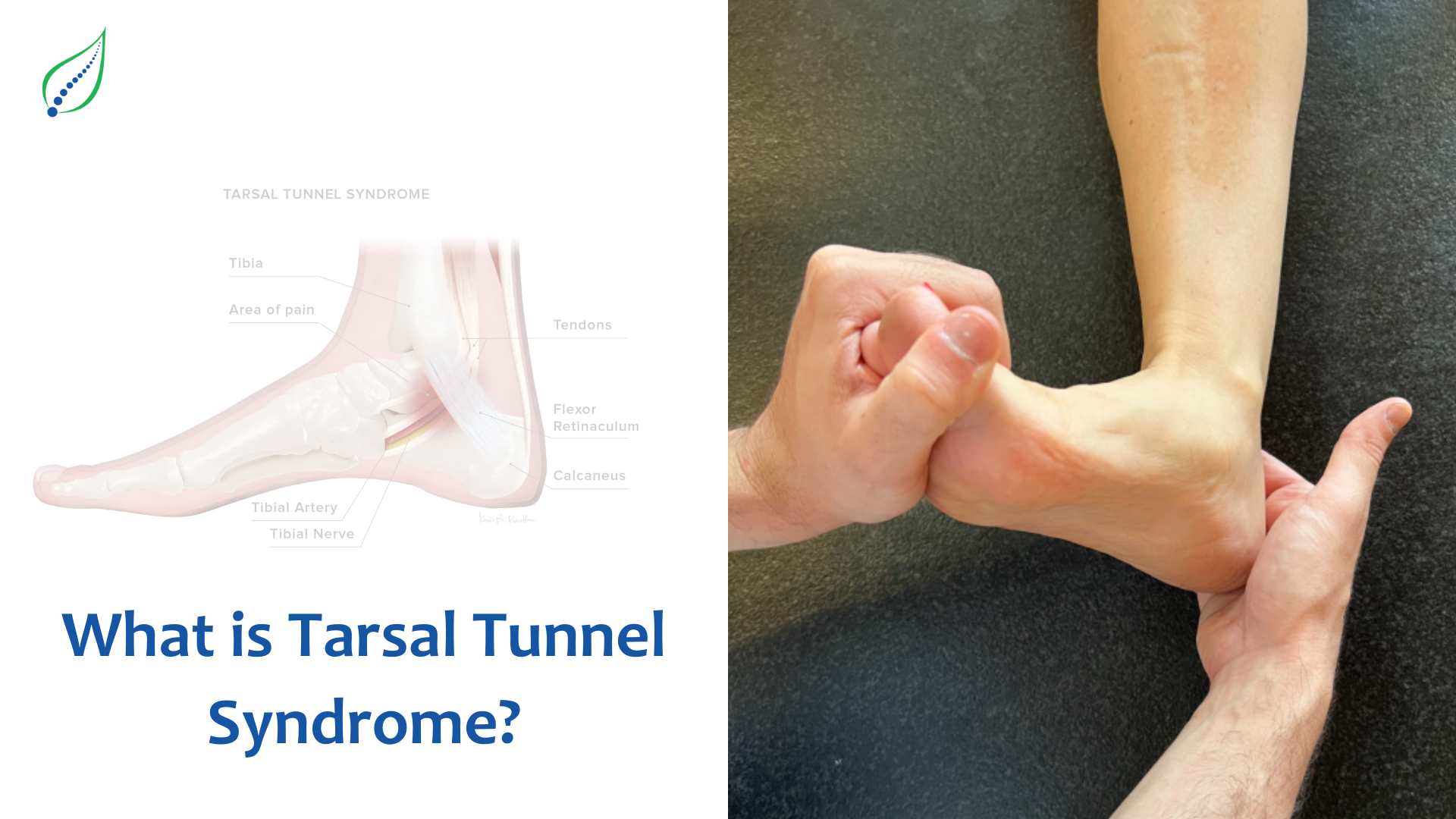 What is Tarsal Tunnel Syndrome?